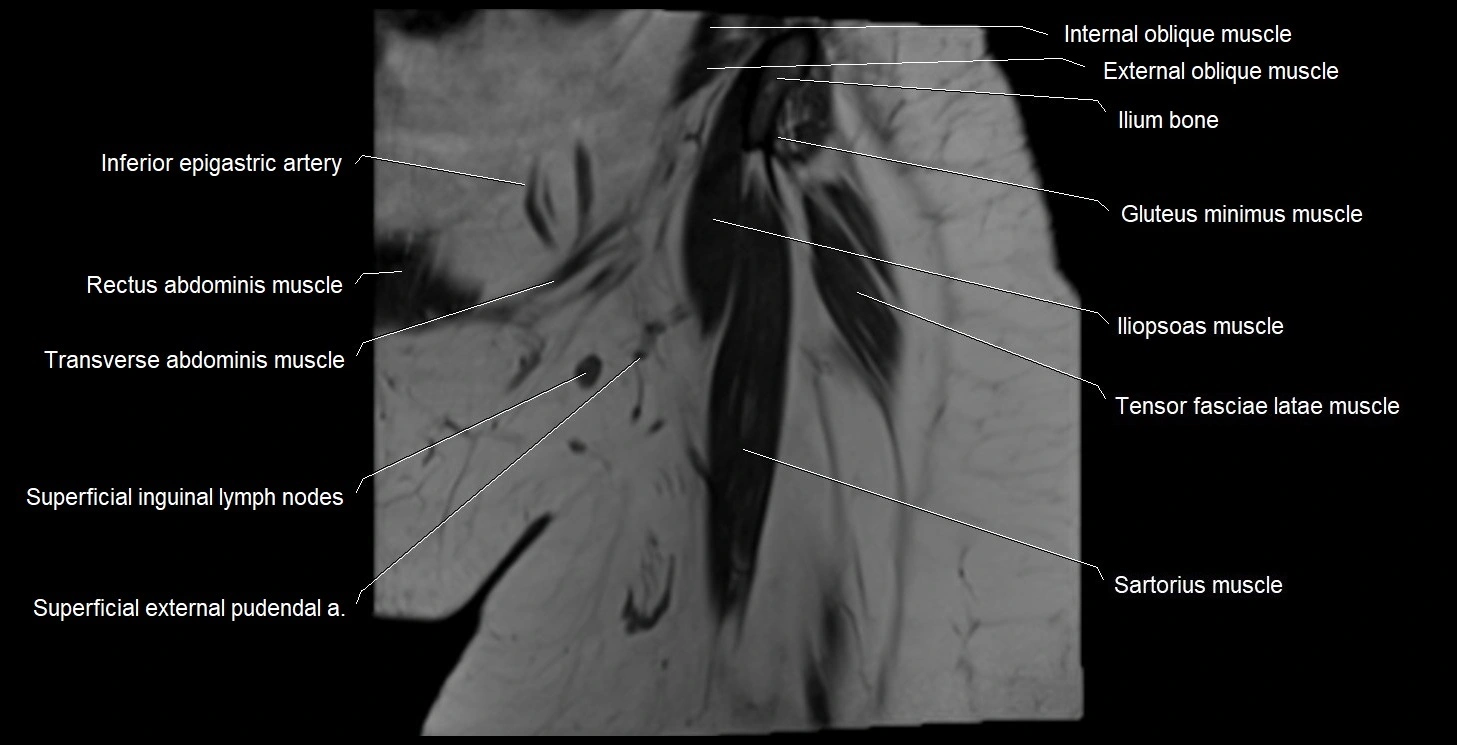 MRI Hip 3T coronal cross sectional anatomy image 3.webp